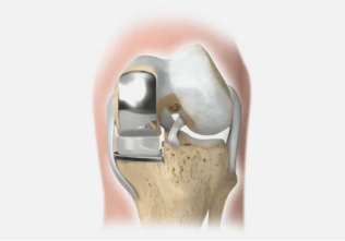 một hư hỏng phần của công ty