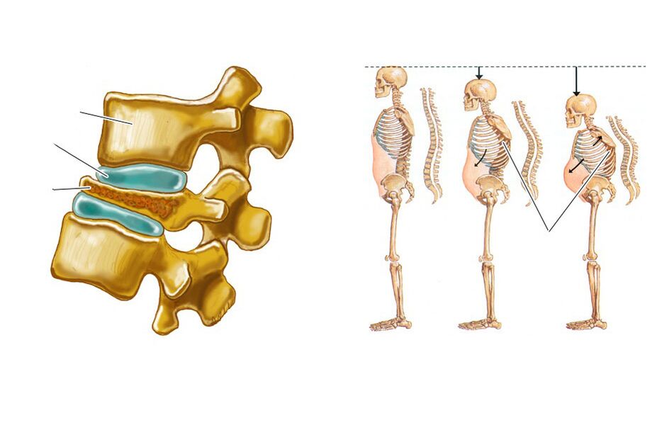 cột sống bị chùng xuống dẫn đến đau lưng