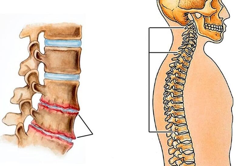 độ cong của cột sống dẫn đến đau lưng