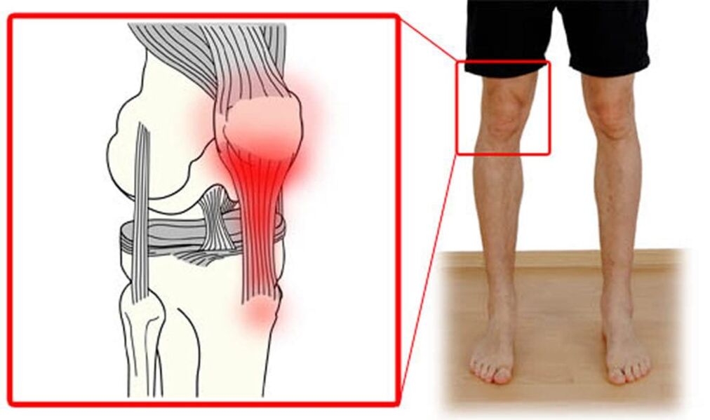 Viêm gân - viêm gân ở khớp gối