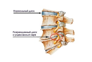 Triệu chứng của cổ bệnh thoái hóa đĩa