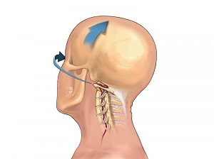 cách biểu hiện của chứng hoại tử xương của cột sống cổ