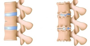 cách nhận biết sự hiện diện của hoại tử xương cột sống thắt lưng