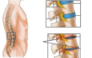 nguyên nhân gây ra hoại tử xương cột sống thắt lưng