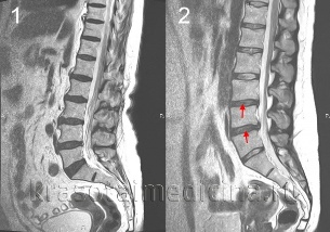 cột sống ngực của bệnh của các cột sống